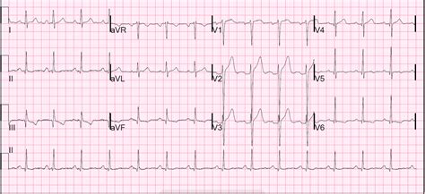 Dr. Smith's ECG Blog: Anterior ST elevation: Anterior STEMI? A mysterious case.