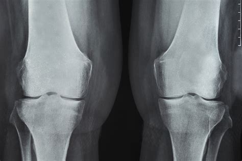 Rheumatoid Arthritis Knee