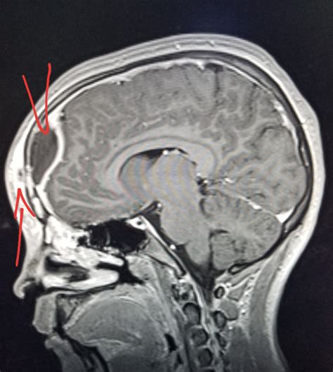 #Brain #MRI: #Pott's puffy tumor: sinus infection extending superfically (arrow) and into # ...