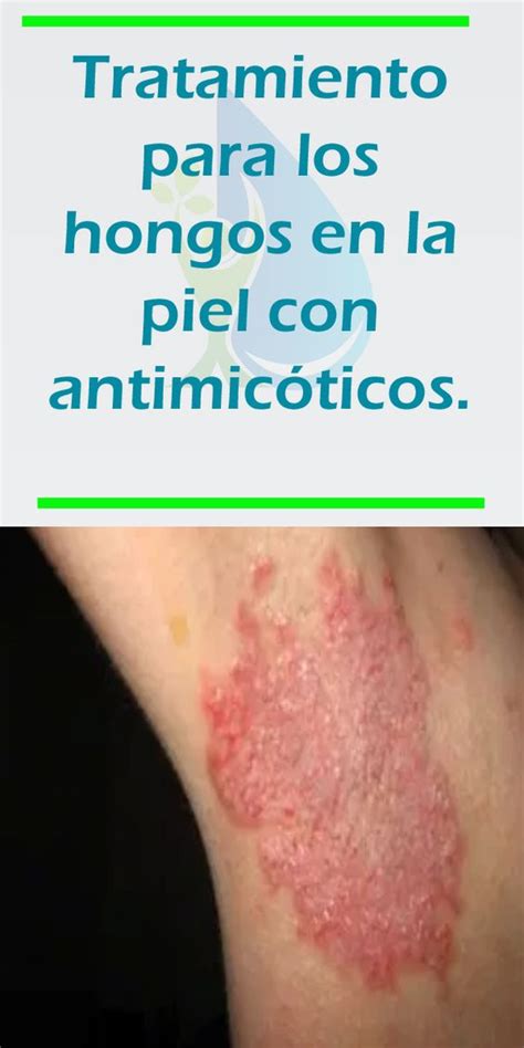 Tratamiento para los hongos en la piel con antimicóticos – Fitness y Salud