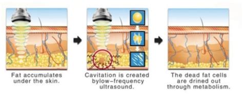 ULTRASONIC CAVITATION - Epic Gems & Extensions