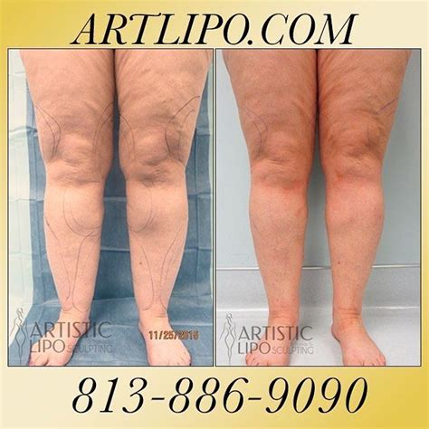 http://www.dietplanlist.com | Tumescent liposuction, Liposuction ...