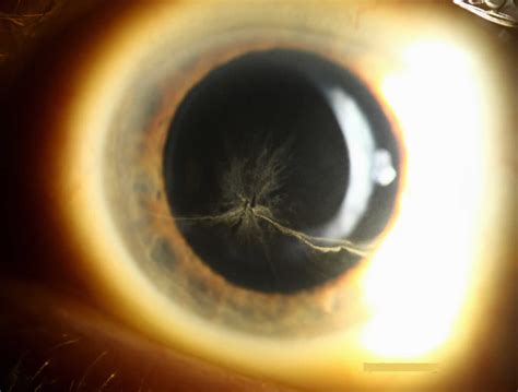 Cornea verticillata, causes, symptoms, diagnosis & treatment