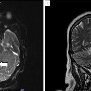 MRI of the brain showing right cerebellar stroke. | Download Scientific Diagram