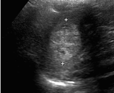 Splenic Hemangioma Ultrasound