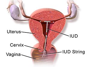 IUD Contraceptive Doctor Minera | Menstrual Bleeding Reduction Canberra ...