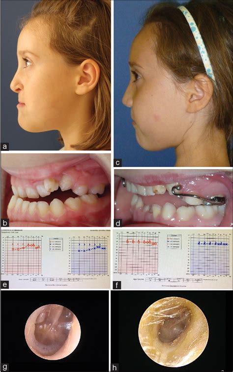 Treatment of maxillary hypoplasia in cleft lip and palate patients: Keeping the total burden of ...