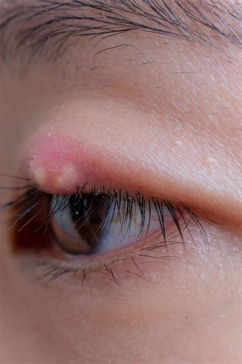 7 ways to treat or get rid of a stye