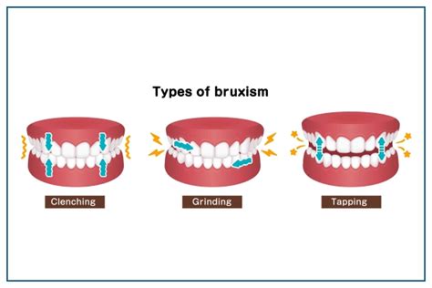 Bruxism: Tips for Teeth Grinding - Chirunavvu Dental Care