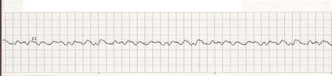 Float Nurse: EKG Rhythm Strips 12- ventricular rhythms