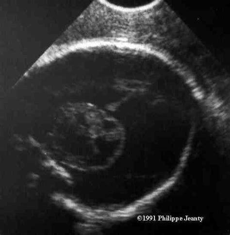 Hydranencephaly Ultrasound