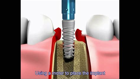 Dental implant procedure - YouTube