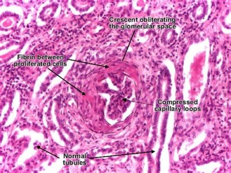 Rapidly Progressive Glomerulonephritis (RPGN) - YouTube