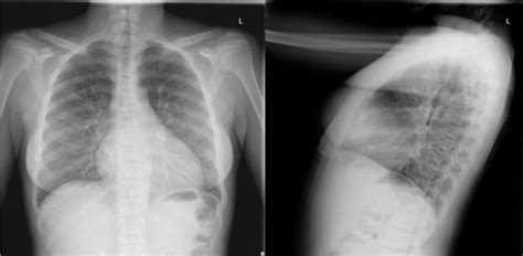 [Figure, Normal chest radiograph in the...] - StatPearls - NCBI Bookshelf