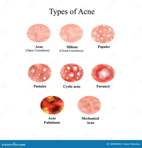 Types Of Acne. Closed Comedones, Open Comedones, Inflamed Acne, Cysts. Inflamed Pimples. The ...