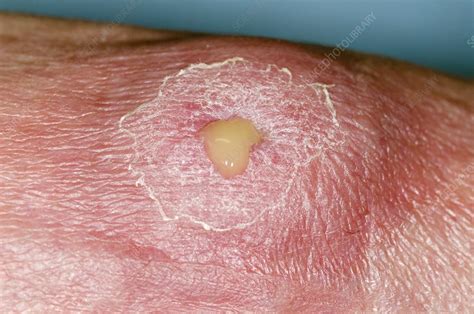 Abscess on the foot - Stock Image - C013/0843 - Science Photo Library