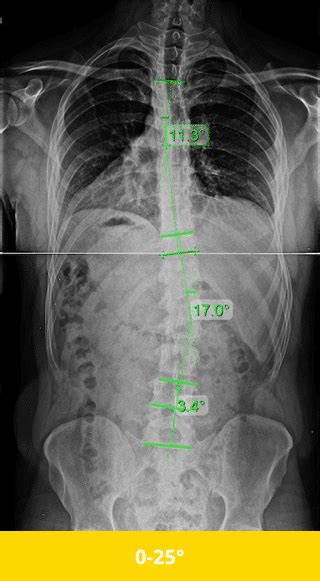 Mild Scoliosis - Symptoms, Treatment, and Surgery