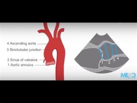 How to identify a thoracic aortic aneurysm using ultrasound - YouTube