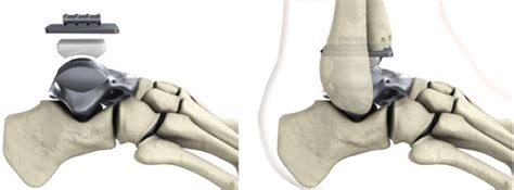 Components of the customized hemiprosthesis for combination with the... | Download Scientific ...