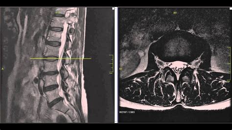 Lumbar Disc Herniation MRI Explained | Dr. Jeffrey P. Johnson | HD ...