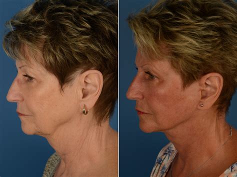 The UpLift™ Lower Face and Neck Lift Photos | Naples, FL | Patient 14461