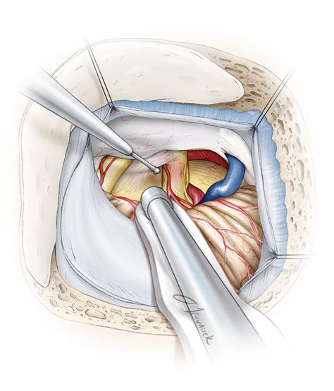 Treatment Option: Microvascular Decompression surgery - Face Facts