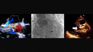 THE CHRONIC LEAKY AORTIC VALVE • MyHeart