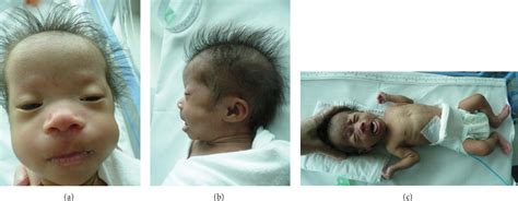 Figure 1 from Monosomy 21 Seen in Live Born Is Unlikely to Represent ...