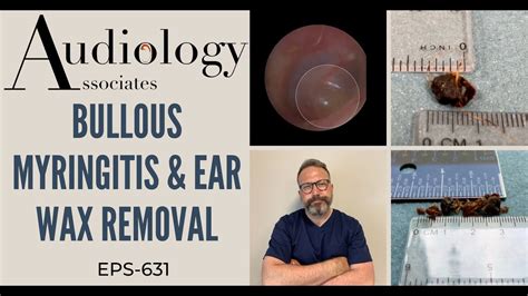 BULLOUS MYRINGITIS & EARWAX REMOVAL - EP631 - YouTube