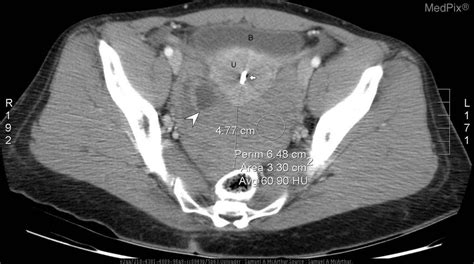 Ruptured Ovarian Cyst