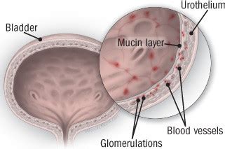 Interstitial Cystitis - Harvard Health