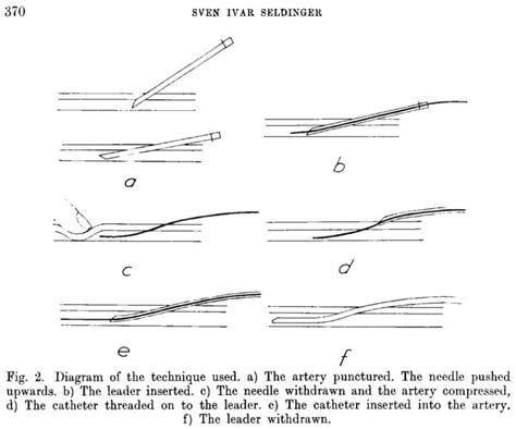 Seldinger Technique • LITFL • Medical Eponym Library