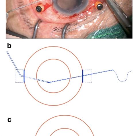 An 8-0 polypropylene suture was knotted with a 10-0 polypropylene ...