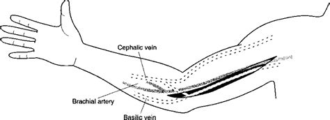 Figure 1 from Transposition of the basilic vein for arteriovenous fistula: an endoscopic ...