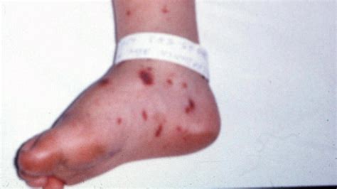 Health warning after case of meningococcal confirmed | Sunshine Coast Daily