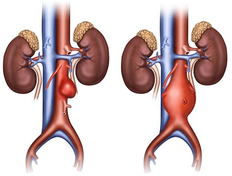 Abdominal Aortic Aneurysm: Endovascular vs. Surgical Repair » Scary ...