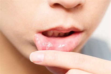 Sore Tongue: 10 Causes of a Sore Tongue