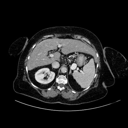 Splenorenal shunt venous aneurysm | Radiology Reference Article ...