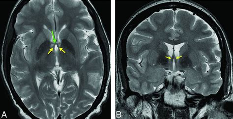 Fornix Brain Mri