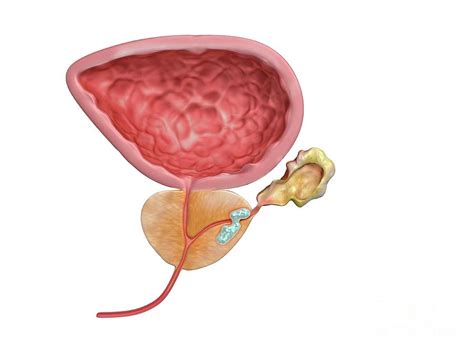 Stage II Prostate Cancer Photograph by Gunilla Elam/science Photo Library