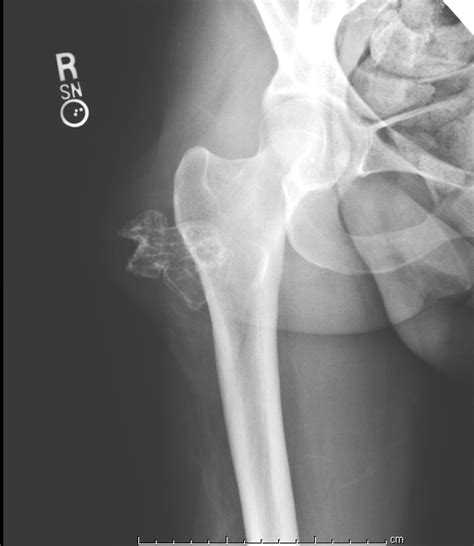 Osteochondroma | BoneTumor.org