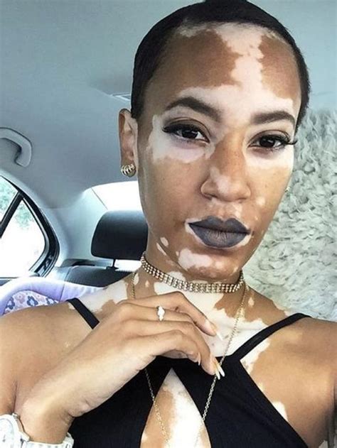 Menderita Vitiligo, Amy Deanna Berhasil Jadi Model yang Mendunia - Lifestyle Fimela.com