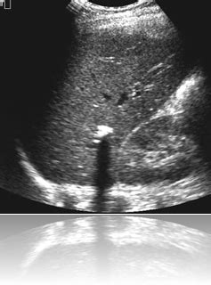 Ultrasound images Granuloma - Radiology Imaging