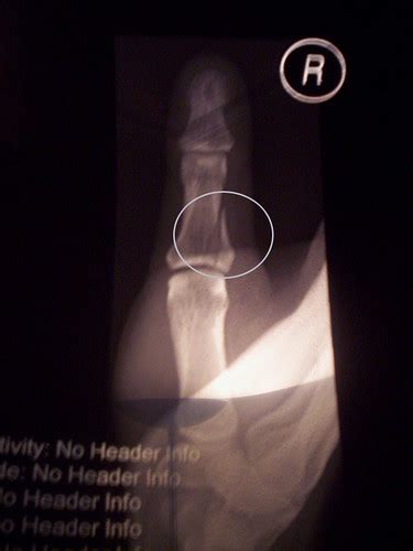 D's broken thumb X-ray | An X-ray from Cumberland Infirmary'… | Flickr