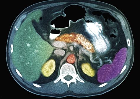 Chronic Pancreatitis: Challenging to Diagnose, Difficult to Treat ...