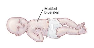 Skin Color Changes in the Newborn