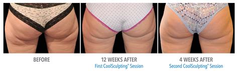 CoolSculpting® | LaserSpa of Tampa Bay