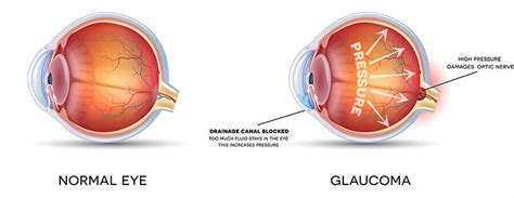 Glaucoma Eye Test