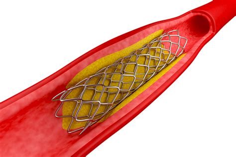 FDA Considers First-Ever Disappearing Heart Stent | Future of You | KQED Future of You | KQED ...