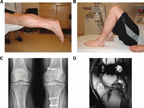 (A) Prone extension of the affected knee with 2 of flexion contracture ...